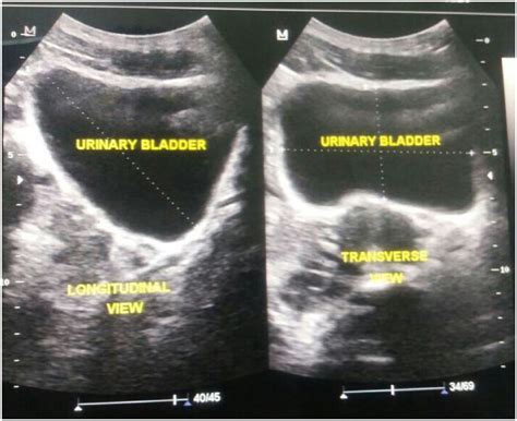 measuring bladder wall thickness ultrasound|bladder wall thickness ultrasound measurement.